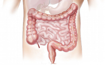 Sindrome del colon irritabile: l’importanza di un’alimentazione corretta